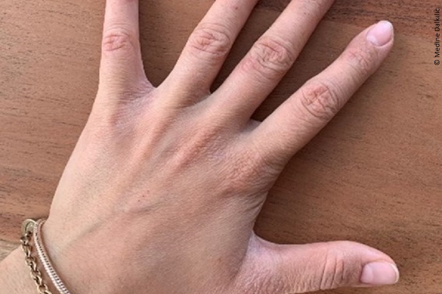 Das Bild einer Hand mit trockener Haut. 